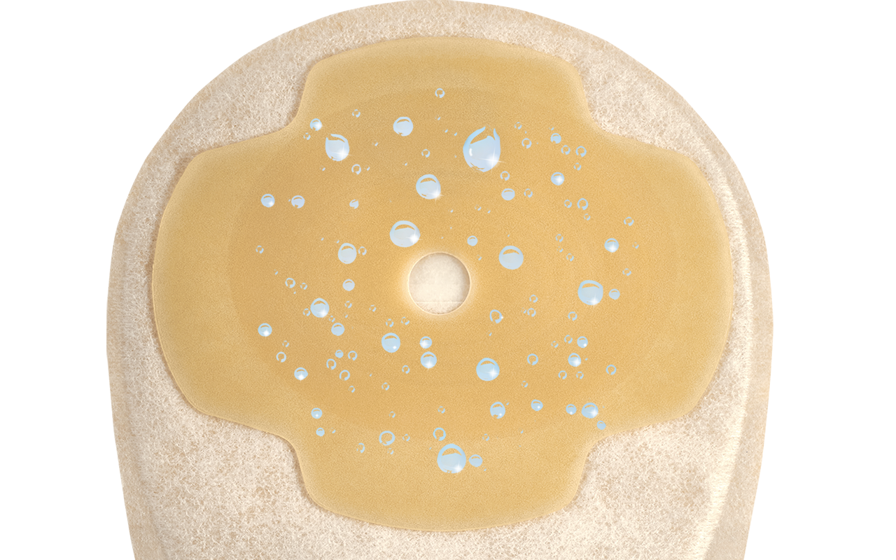 Peristomal hudhälsa och högabsorberande hydrokolloider – kliniska aspekter och evidens