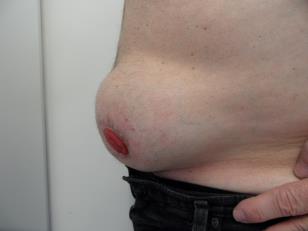 Buktningar vid stomi – förståelse, stöd och vägledning